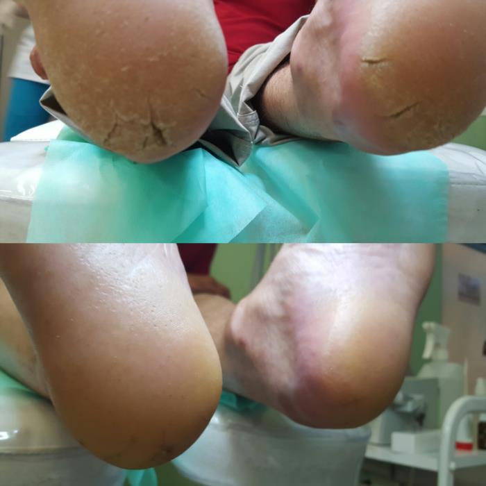 Аппаратный педикюр в Хмельницком - изображениe 1