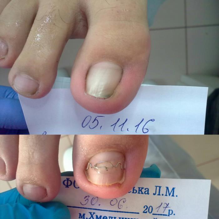 Аппаратный педикюр в Хмельницком - изображениe 3