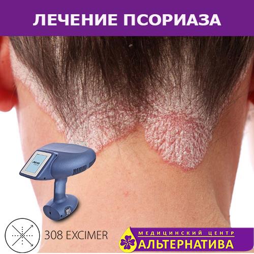 Лечение псориазаЭксимер лазер 380 нм - изображениe 3