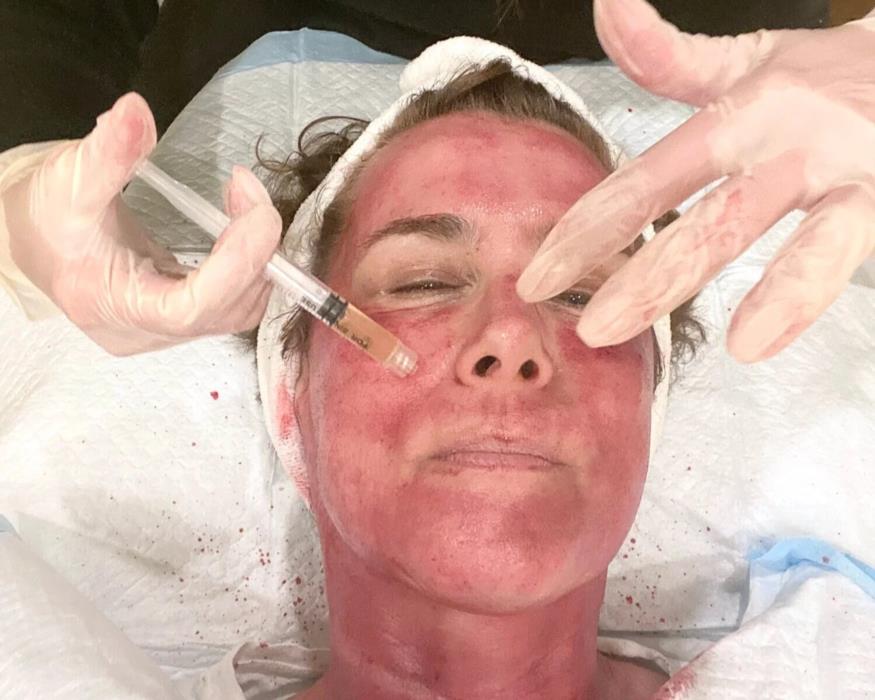 Косметологія Плазмотерапія PRPPPP - изображениe 7