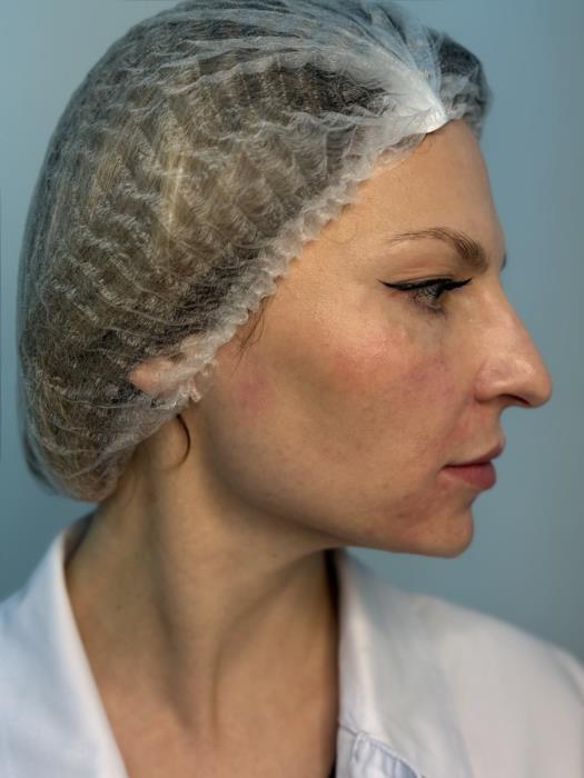 Косметологія Плазмотерапія PRPPPP - изображениe 9