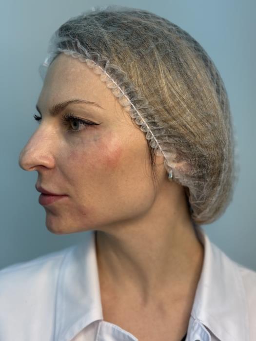 Косметологія Плазмотерапія PRPPPP - изображениe 10